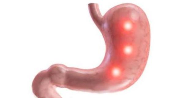 Membedakan Radang Lambung dengan Maag • Konsultasi 